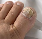 Easy remedies for toenail fungus