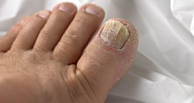 Easy remedies for toenail fungus